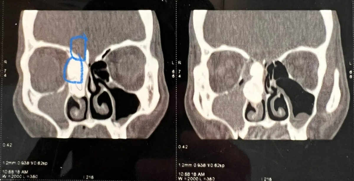 Hình ảnh CT scanner khối u xương chạm tới màng não, bộc lộ cả nền sọ và mắt