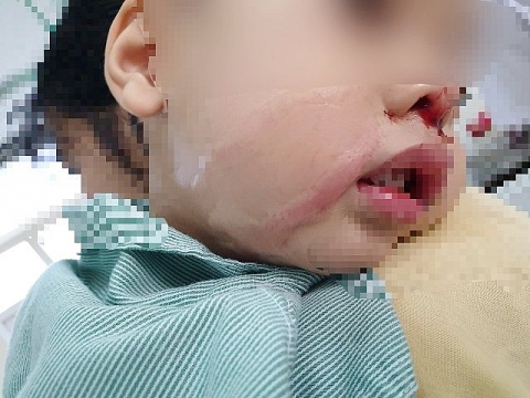 Mẹ nhỏ nhầm axit vào mũi khiến con trai bị bỏng nặng